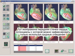 Изображение на кардиовизоре Изображение на кардиовизоре