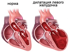 дистония левого желудочка сердца